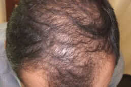 Alopecia diffusa - diffuser Haarausfall